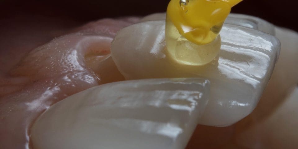 yaprak porselen lamina