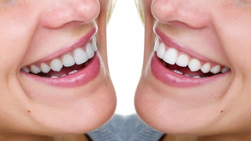 nevşehir diş beyazlatma