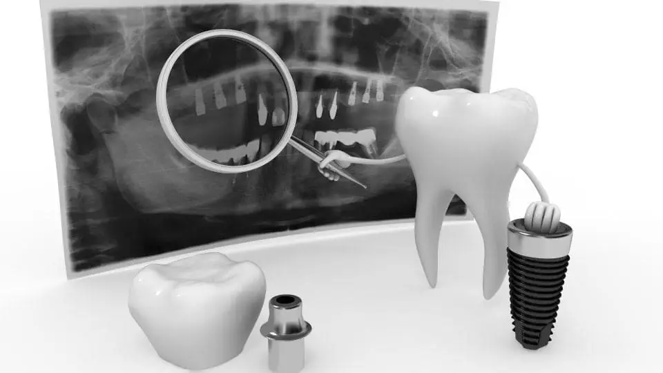 yapay zeka ve implant diş tedavileri