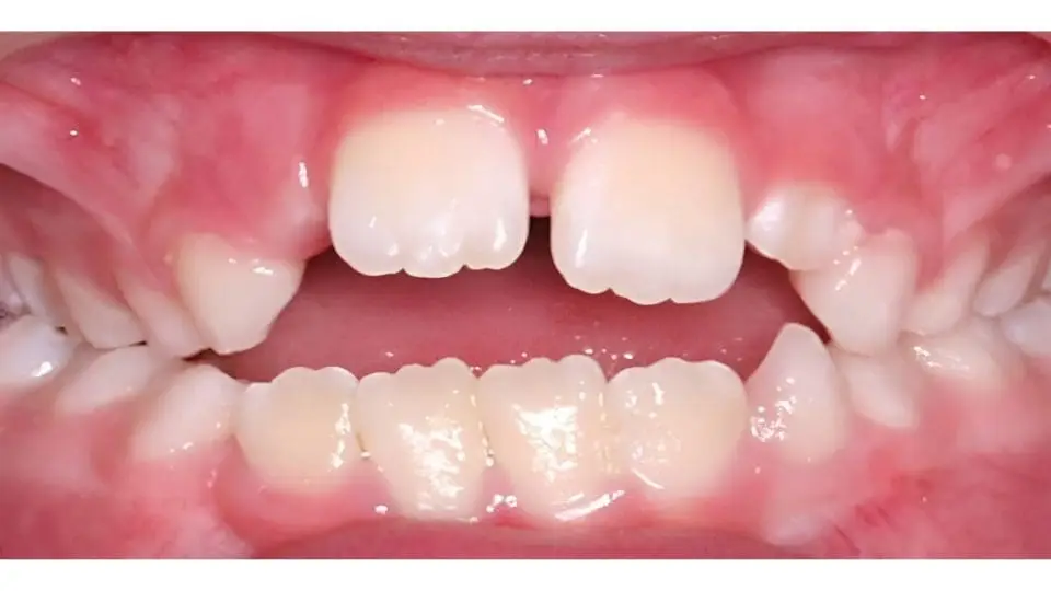 cocuklarda firlak dis