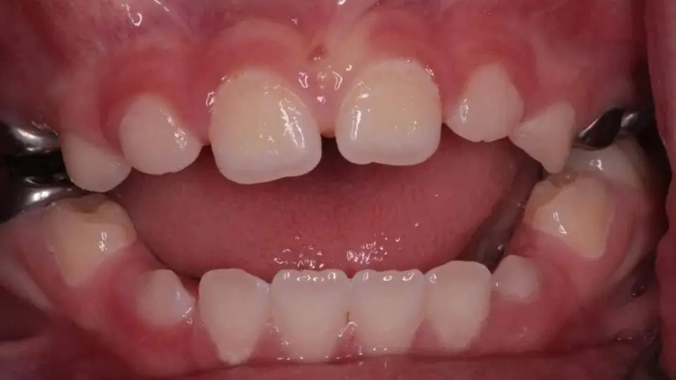 çocuklarda open bite